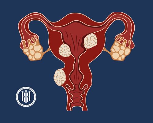 Miyomektomi (Miyom Alma) Ameliyatı