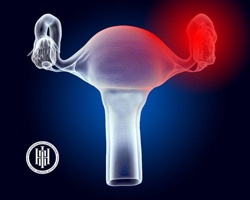 Overal / Paraovaryan Kist Eksizyonu Ameliyatı