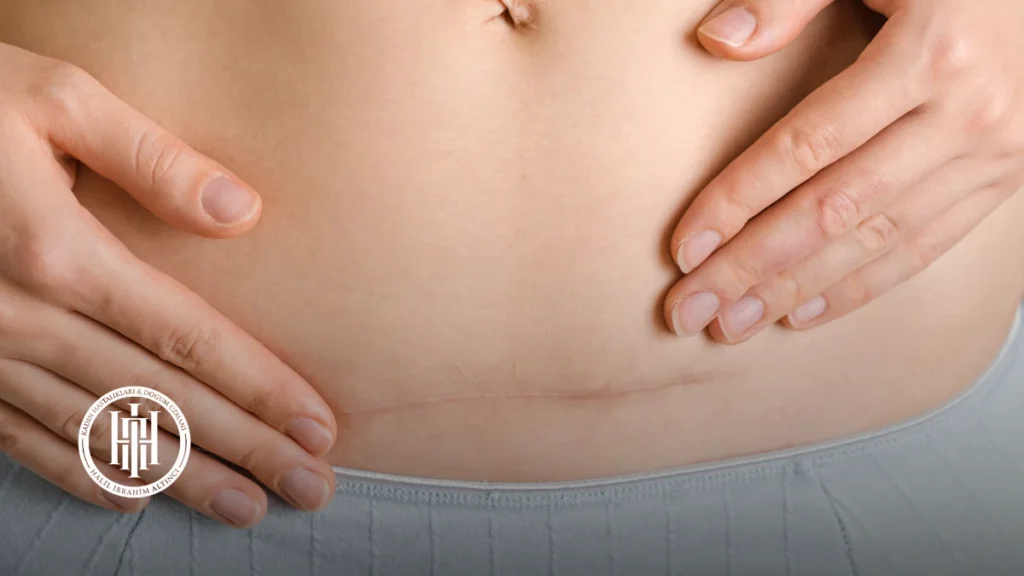 İstmosel Tedavisi: Sezaryen Sonrası İnfertilite Çözümleri